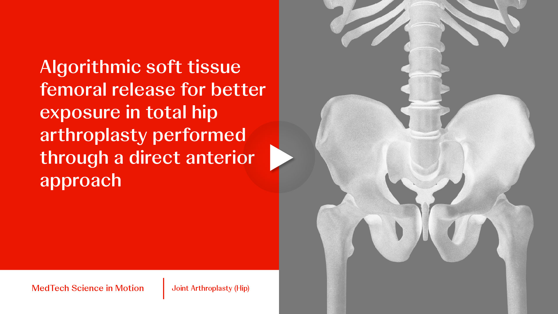 thumb Algorithmic soft tissue femoral release for better exposure in total hip arthroplasty performed through a DAA