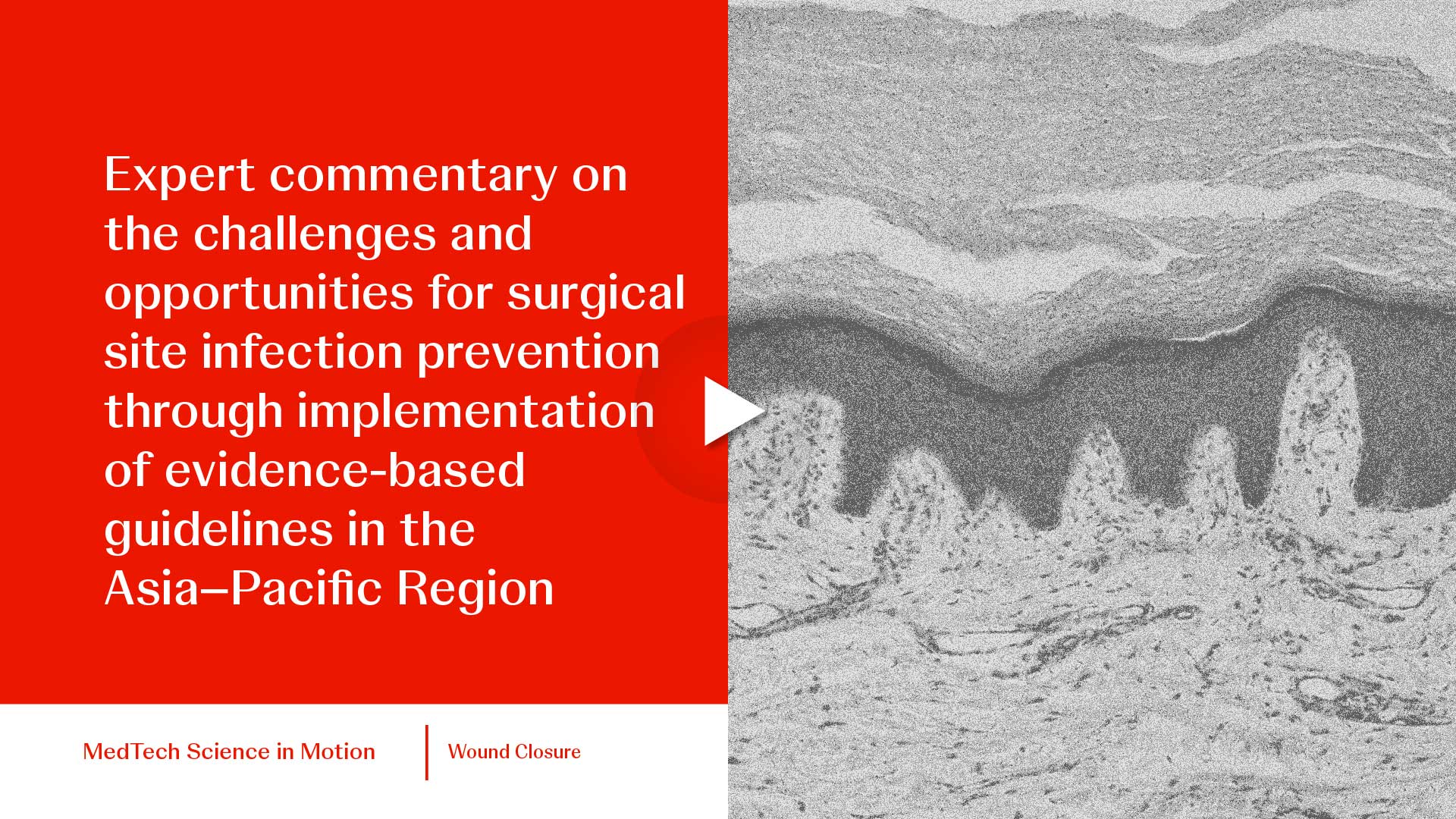 thumb Expert commentary on the challenges and opportunities for surgical site infection