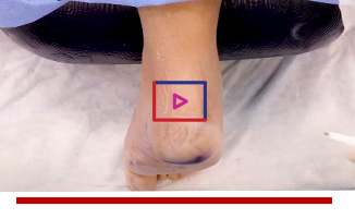 Flexor Digitorum Longus Tendon Transfer - Michael Campbell, MD Image