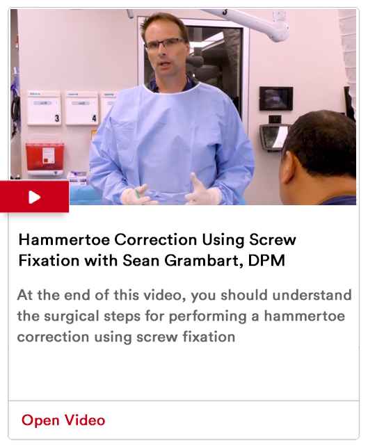 Hammertoe Correction Using Screw Fixation Image