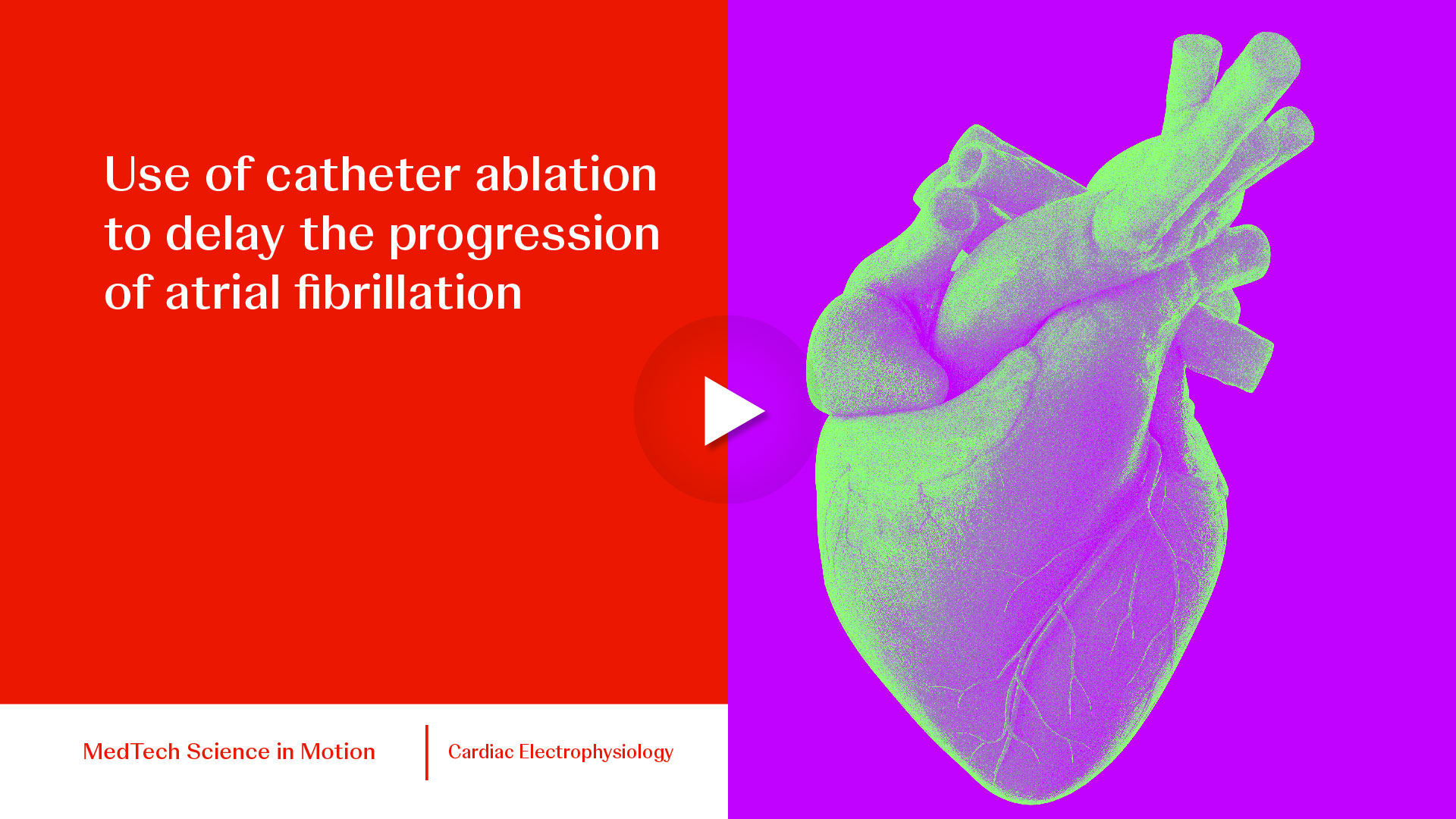 thumb Use of catheter ablation to delay the progression of atrial fibrillation