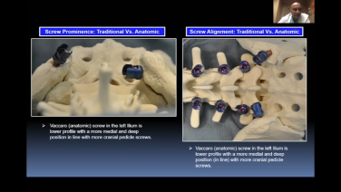 An image from the "Sacropelvic Fixation & Iliac Crest Graft Surgical Demonstration: Screw Placement with Rajesh Arakal, MD" video on the JnJInstitute.com website.