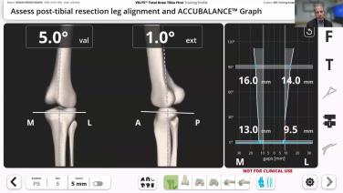 VELYS Robotic-Assisted Solution Case Walkthrough with Dr. William Barrett thumbnail