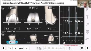VELYS Robotic-Assisted Solution Case Walkthrough with Dr. Christopher Drinkwater thumbnail image